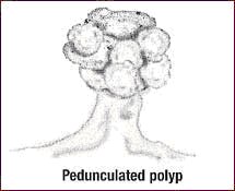 pedunculated_polyp